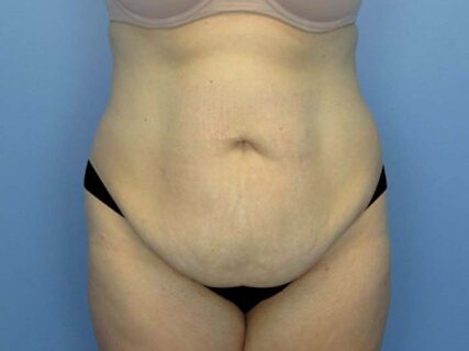 Abdominal Liposuction vs Tummy Tuck - Little Rock, AR - Conway, AR